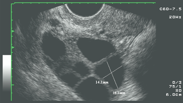 OVARIAN HYPERSTIMULATION SINDROME (OHSS) IN FERTILITY TREATMENTS (IVF)